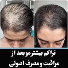 پک ۴ ماهه قطع ریزش و رویش مجدد مو